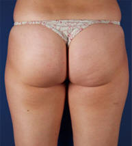 fesses et cuisses après traitement, peau lisse et amincissement