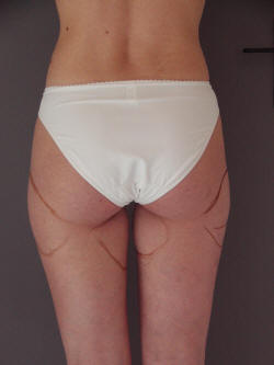 culotte de cheval avant lyse ondes de choc