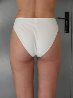 culotte de cheval amincie apès traitement lyse