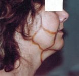 ovale du visage avant lipoponction