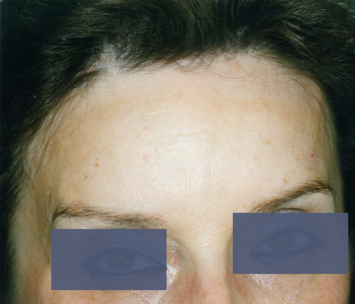 botox sur les rides du front apr�s injections