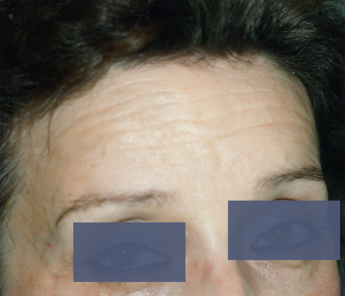 botox sur les rides du front avant