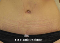 peau du ventre apr�s carboxytherapie