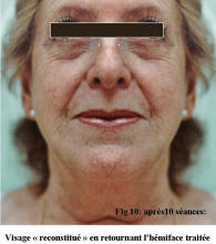 visage apr�s carboxitherapie
