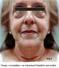 visage avant injection carboxitherapie
