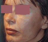 injections non resorbables apres