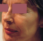 injections non resorbables avant
