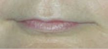 l�vres avant dermo-pigmentation