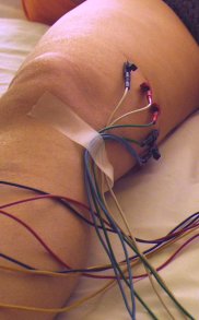 séance d'électrolipolyse sur la jambe