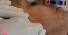 implantation de fils crant�s tenseurs