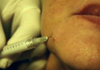 injection antirides sur visage