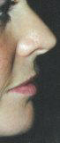 nez corrig� par rhinoplastie m�dicale
