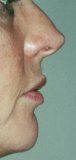 d�faut du nez avant injection remodelante 