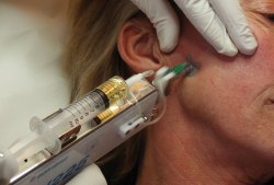 injections de mesolift au pistolet sur le bas du visage