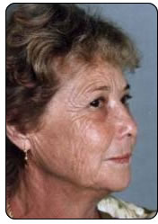 peeling moyen avant