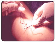 �veinage : ablation d'une veine
