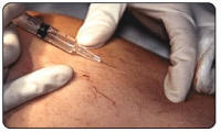 injection scl�rosante de vaisseaux rouges sur la cuisse