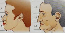 nez de profil et defaut de l'arete