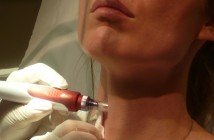 microneedling (4)