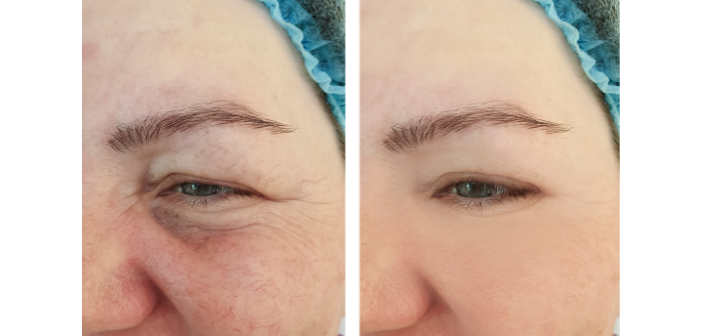 Avant et après traitement pour couperose