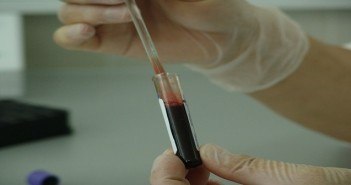 L’injection de plasma riche en plaquettes ou ‘’PRP » L’INJECTION DE PLASMA