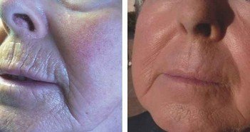 Un point sur le peeling au phénol