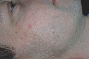 Résultat sur cicatrices d'acné après 4 séances.
