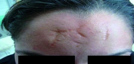 Cicatrices d’acné