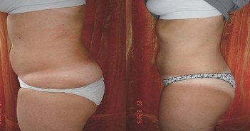 Ultrasons et cryotherapie : effets sur la cellulite Cellulite
