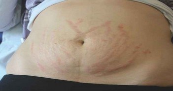 Laser fractionne vs peelings contre les vergetures LES TRAITEMENTS DES VERGETURES