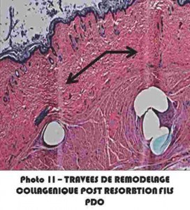 Remodelage collagenique