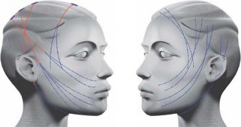 Fils tenseurs ou de suspension : le marketing peut-il tout se permettre ? fils crantés sur le visage