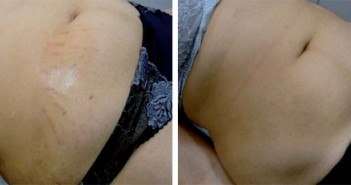 Vergetures : peut-on toutes les traiter ?