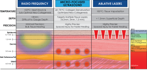 Tableau comparatif RF-US-Laser