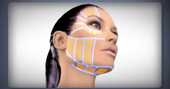 ULTHERAPY° après un an d’utilisation appareil à ultrasons
