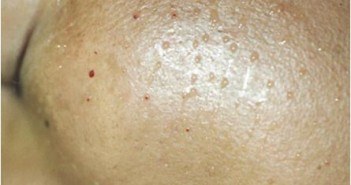 Acide hyaluronique et hydratation cutanée en mésothérapie