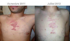 Jeune homme de 23 ans. Chéloïdes du torse 3 C02 + Corticoïde intra lésionnel+ LED 4 séances