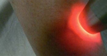 Télangiectasies et photothérapie laser à double longueur d’onde laser vasculaire sur jambe