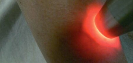 laser vasculaire sur jambe