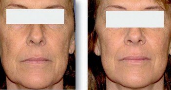 LED et associations de soins esthétiques Visage après traitement LED