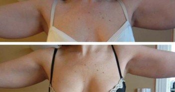 Comment lutter contre le relâchement cutané? relachement de la peau des bras