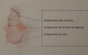 suture élastique en silicone,