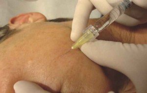 Technique d’injection