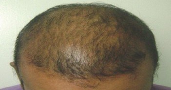 Mésothérapie et chute de cheveux Mésothérapie et chute de cheveux