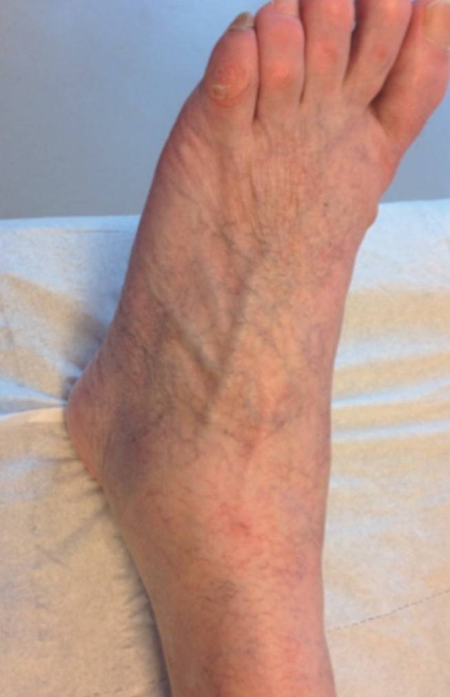 tratamentul lviv varicoz gimnastica pentru prevenirea picioarelor varicoase