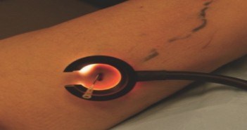Des résultats esthétiques sur les télangiectasies par microsclérose Thrombectomie à l’aiguille, sous transillumination.