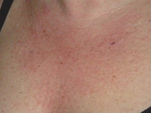 Nappage puis micro-papules AH +multvitamines au pistolet