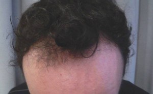 Alopecie