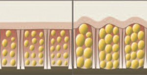 La physiopathologie du développement des nodules de cellulite