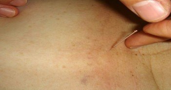 Le ‘’lifting’’ par acupuncture
